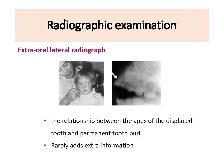 Radiographic examination Extra-oral lateral radiograph • the relationship between the apex of the displaced
