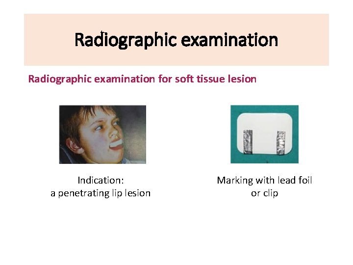 Radiographic examination for soft tissue lesion Indication: a penetrating lip lesion Marking with lead