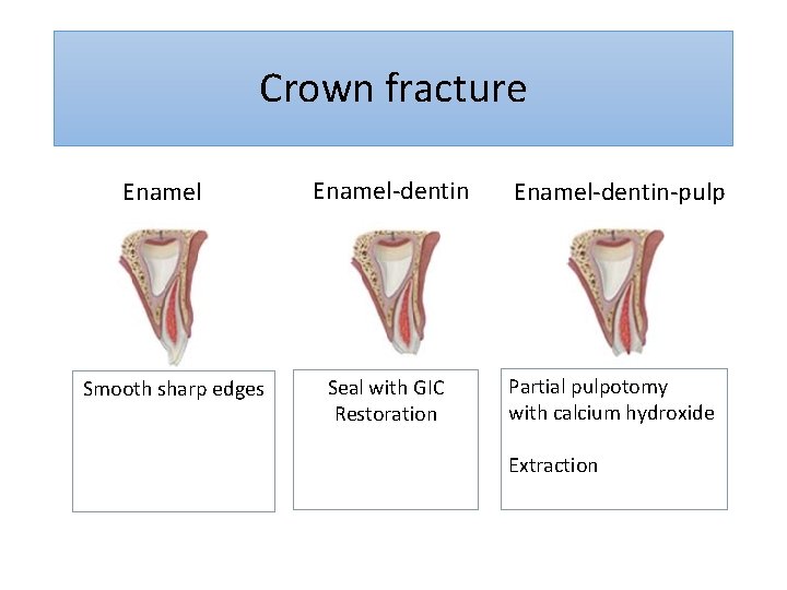 Crown fracture Enamel Smooth sharp edges Enamel-dentin Seal with GIC Restoration Enamel-dentin-pulp Partial pulpotomy