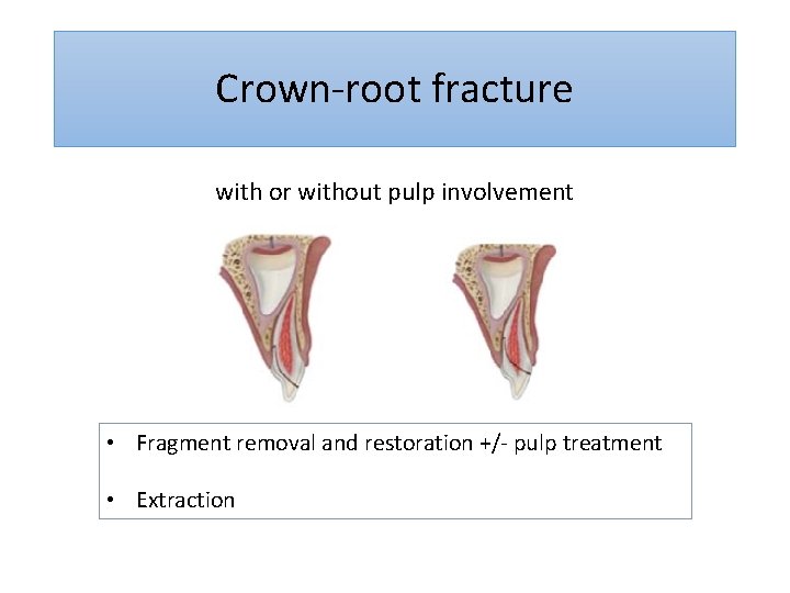 Crown-root fracture with or without pulp involvement • Fragment removal and restoration +/- pulp
