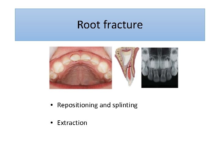 Root fracture • Repositioning and splinting • Extraction 