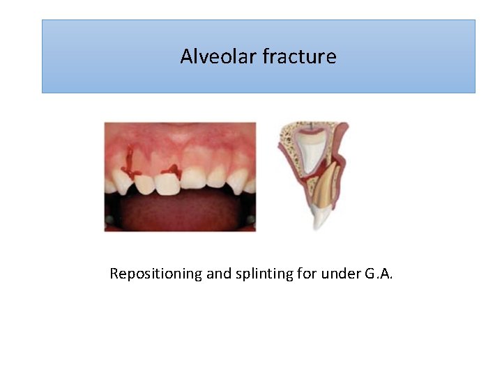 Alveolar fracture Repositioning and splinting for under G. A. 