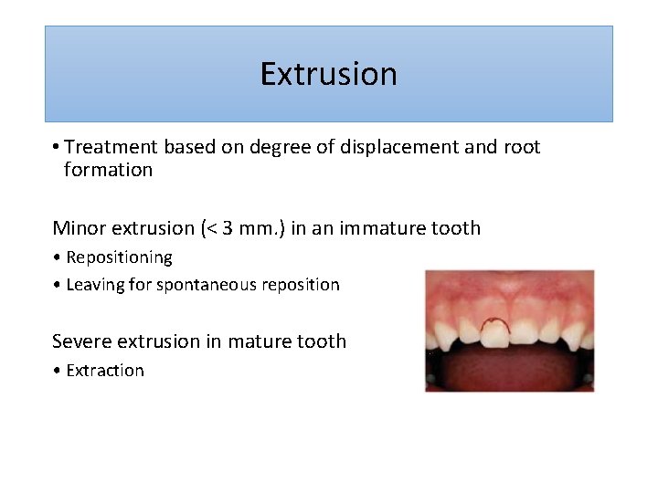 Extrusion • Treatment based on degree of displacement and root formation Minor extrusion (<
