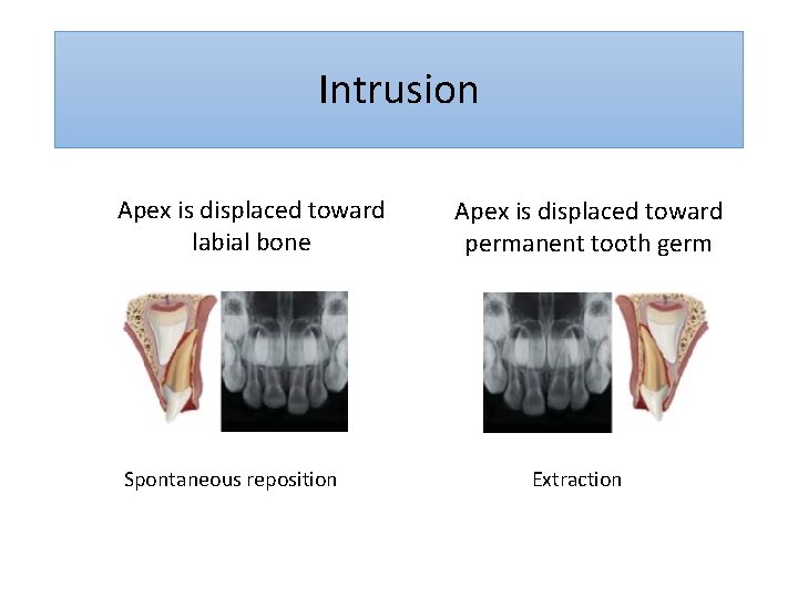 Intrusion Apex is displaced toward labial bone Spontaneous reposition Apex is displaced toward permanent