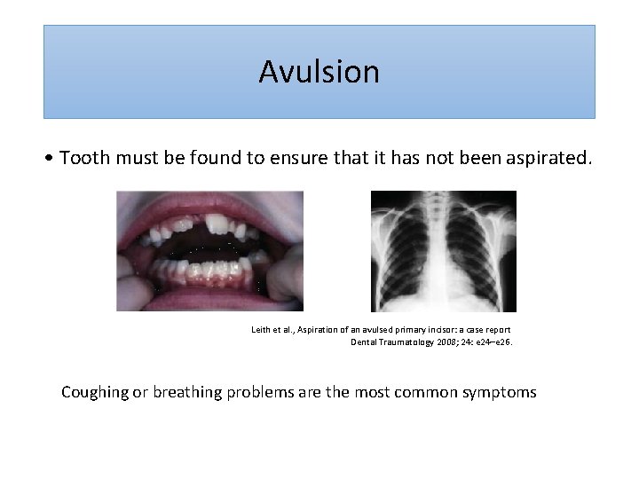 Avulsion • Tooth must be found to ensure that it has not been aspirated.