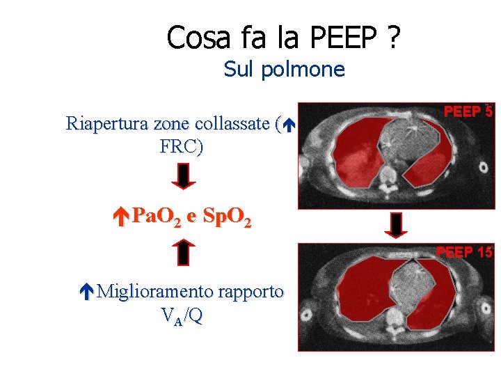 Cosa fa la PEEP ? Sul polmone Riapertura zone collassate ( FRC) PEEP 5