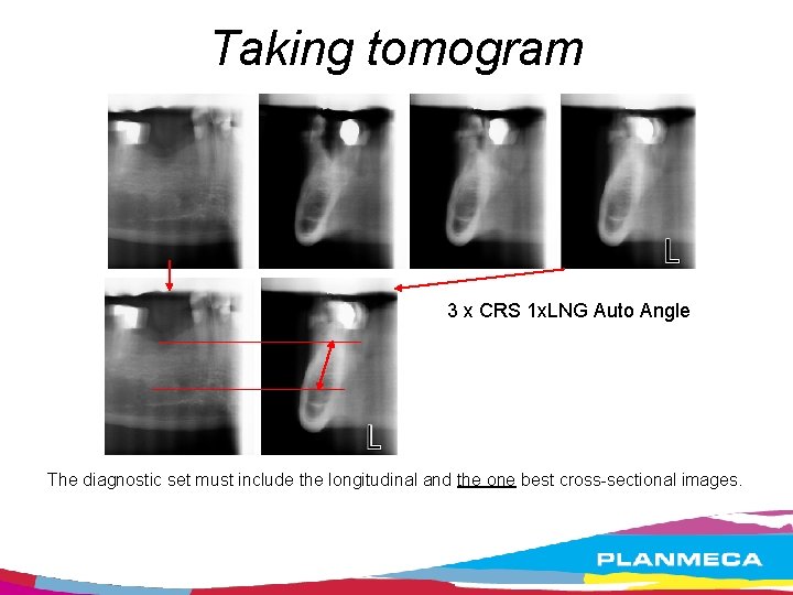 Taking tomogram 3 x CRS 1 x. LNG Auto Angle The diagnostic set must