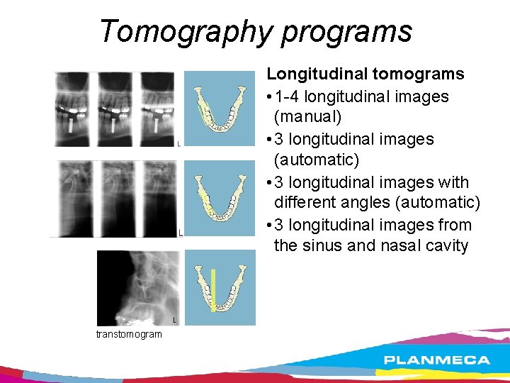 Tomography programs Longitudinal tomograms • 1 -4 longitudinal images (manual) • 3 longitudinal images