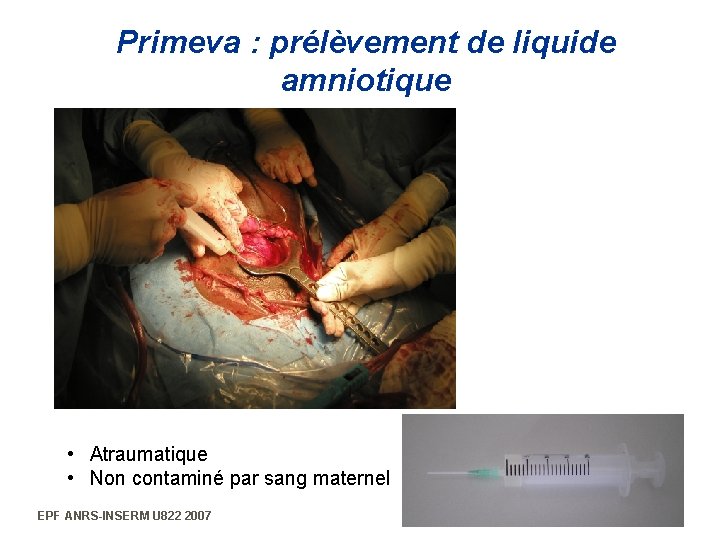 Primeva : prélèvement de liquide amniotique • Atraumatique • Non contaminé par sang maternel