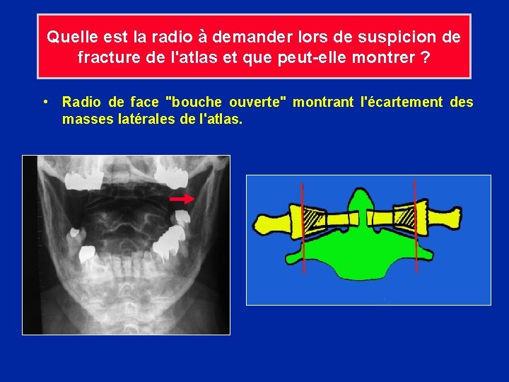 Quelle est la radio à demander lors de suspicion de fracture de l'atlas et