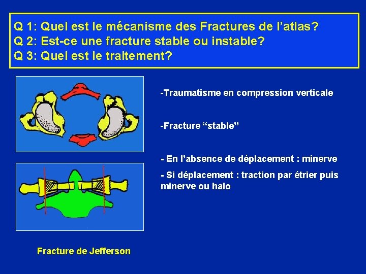 Q 1: Quel est le mécanisme des Fractures de l’atlas? Q 2: Est-ce une