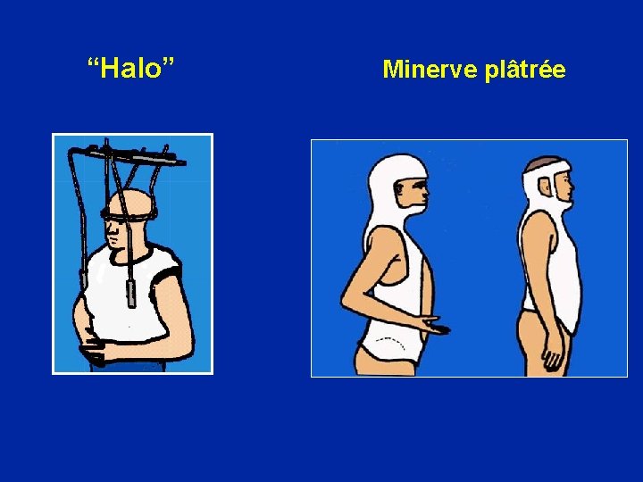  “Halo” Minerve plâtrée 