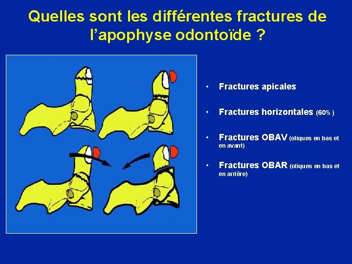 Quelles sont les différentes fractures de l’apophyse odontoïde ? • Fractures apicales • Fractures
