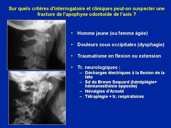 Sur quels critères d'interrogatoire et cliniques peut-on suspecter une fracture de l'apophyse odontoïde de