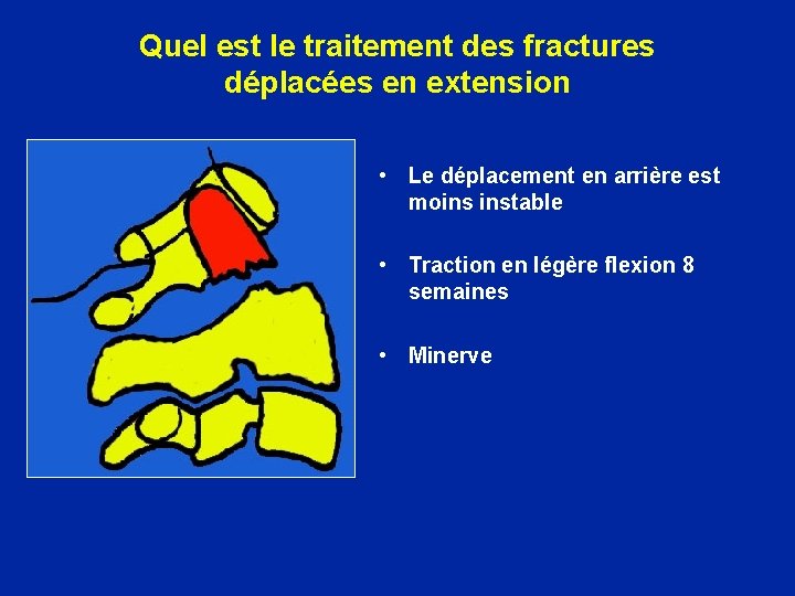 Quel est le traitement des fractures déplacées en extension • Le déplacement en arrière