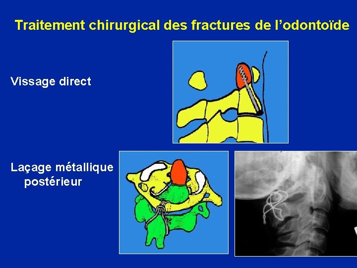 Traitement chirurgical des fractures de l’odontoïde Vissage direct Laçage métallique postérieur 