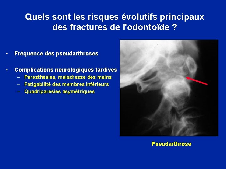 Quels sont les risques évolutifs principaux des fractures de l'odontoïde ? • Fréquence des