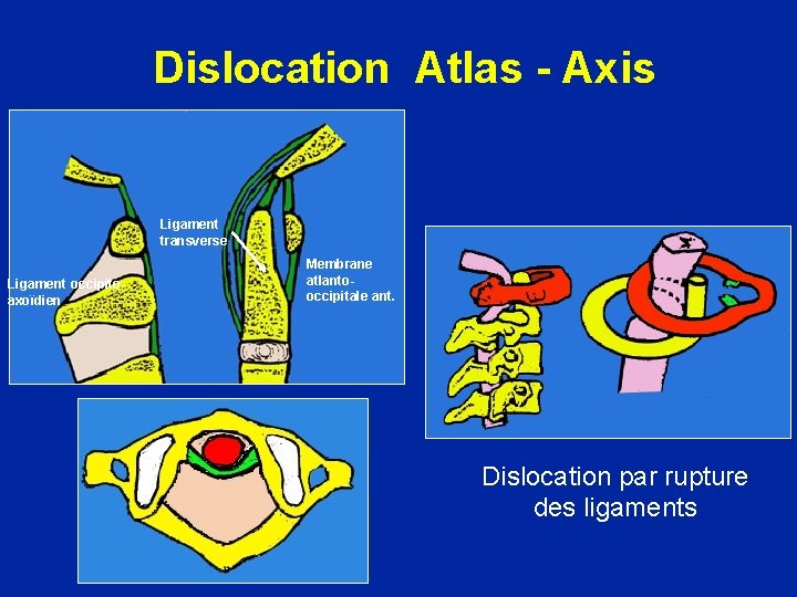 Dislocation Atlas - Axis Ligament transverse Ligament occipitoaxoïdien Membrane atlantooccipitale ant. Dislocation par rupture