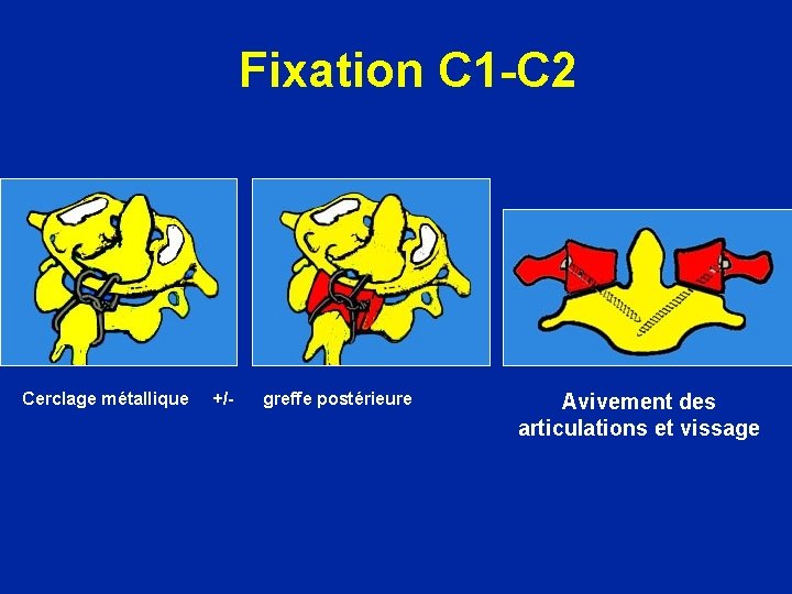 Fixation C 1 -C 2 Cerclage métallique +/- greffe postérieure Avivement des articulations et