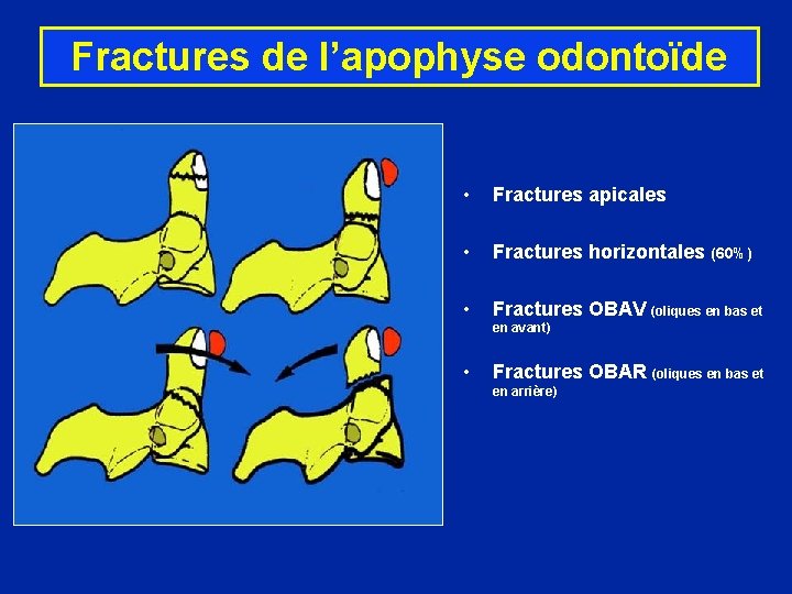 Fractures de l’apophyse odontoïde • Fractures apicales • Fractures horizontales (60%) • Fractures OBAV