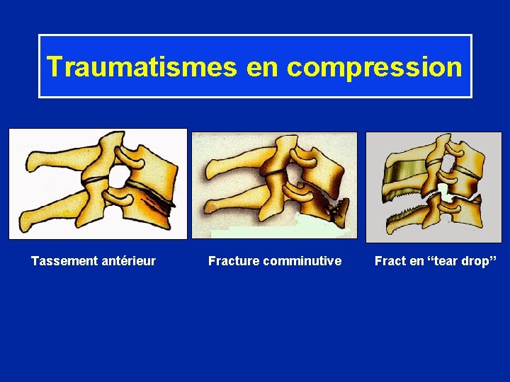 Traumatismes en compression Tassement antérieur Fracture comminutive Fract en “tear drop” 