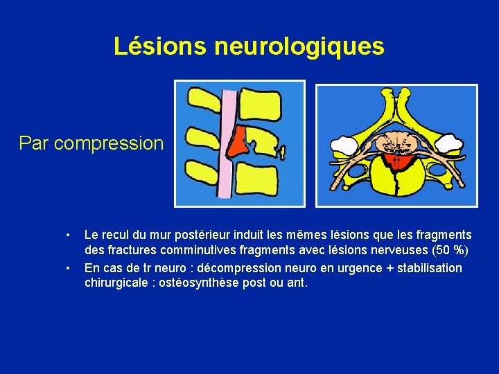 Lésions neurologiques Par compression • • Le recul du mur postérieur induit les mêmes