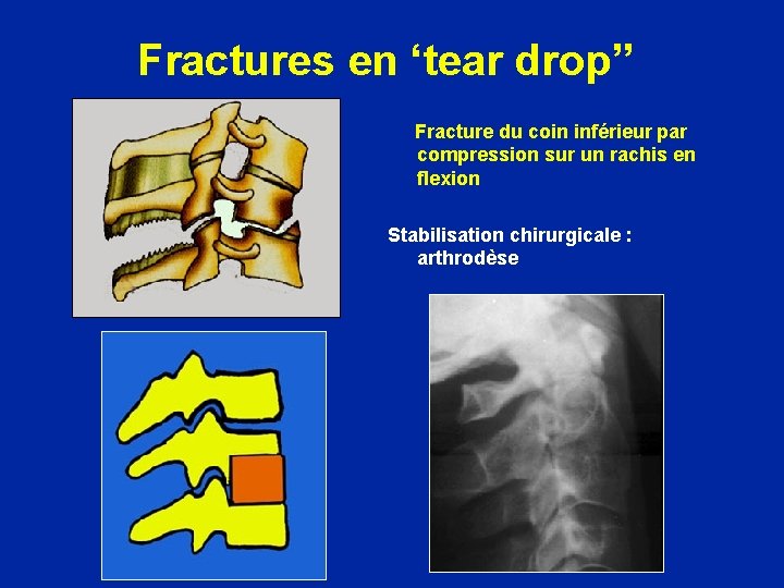 Fractures en ‘tear drop” Fracture du coin inférieur par compression sur un rachis en