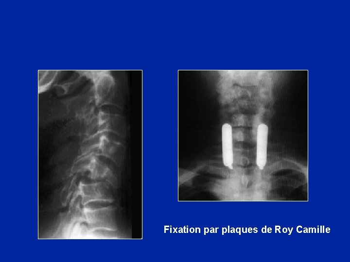  Fixation par plaques de Roy Camille 