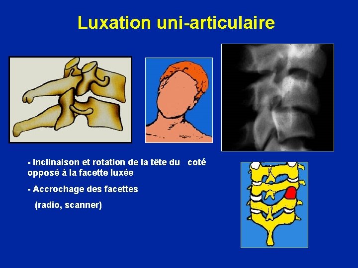 Luxation uni-articulaire - Inclinaison et rotation de la tête du coté opposé à la