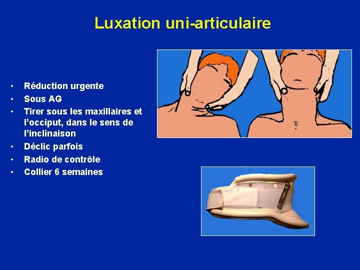 Luxation uni-articulaire • • • Réduction urgente Sous AG Tirer sous les maxillaires et