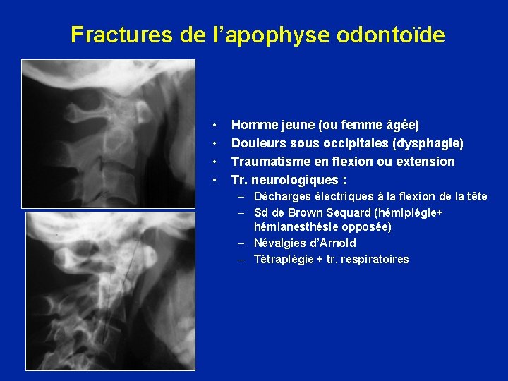 Fractures de l’apophyse odontoïde • • Homme jeune (ou femme âgée) Douleurs sous occipitales