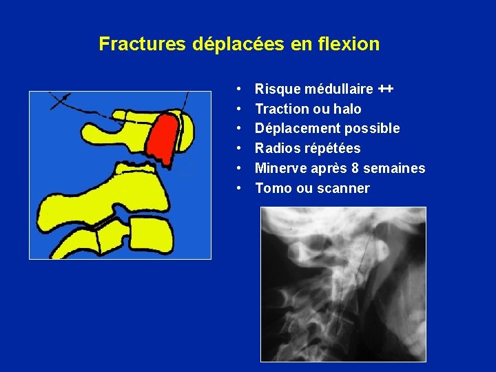 Fractures déplacées en flexion • • • Risque médullaire ++ Traction ou halo Déplacement