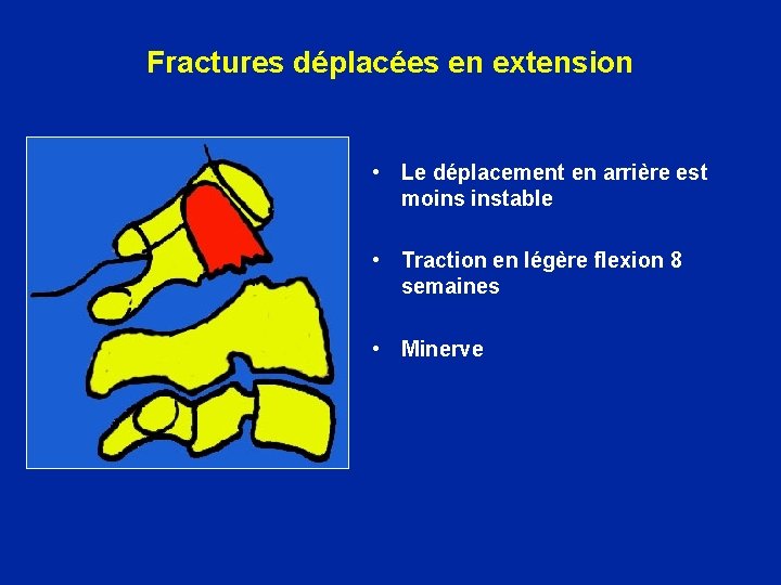 Fractures déplacées en extension • Le déplacement en arrière est moins instable • Traction