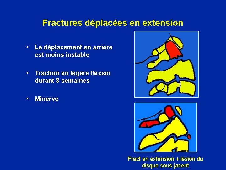 Fractures déplacées en extension • Le déplacement en arrière est moins instable • Traction