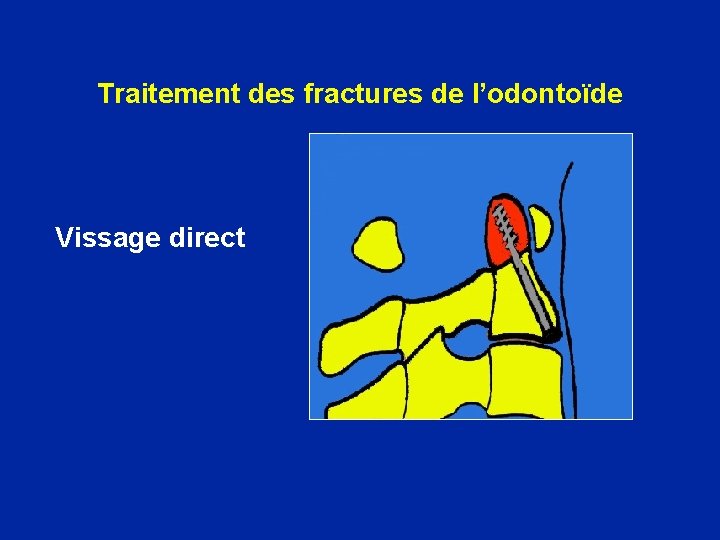 Traitement des fractures de l’odontoïde Vissage direct 