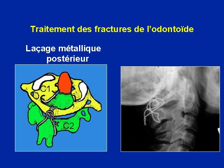 Traitement des fractures de l’odontoïde Laçage métallique postérieur C 1 C 2 