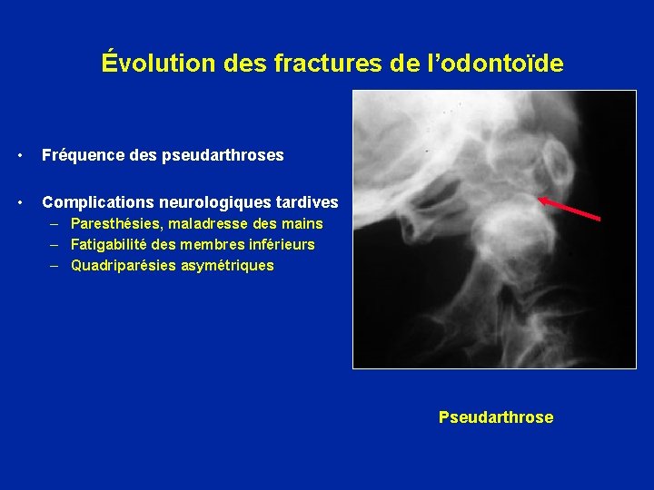 Évolution des fractures de l’odontoïde • Fréquence des pseudarthroses • Complications neurologiques tardives –