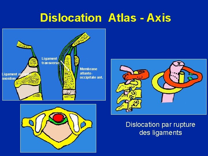 Dislocation Atlas - Axis Ligament transverse Ligament occipitoaxoïdien Membrane atlantooccipitale ant. Dislocation par rupture