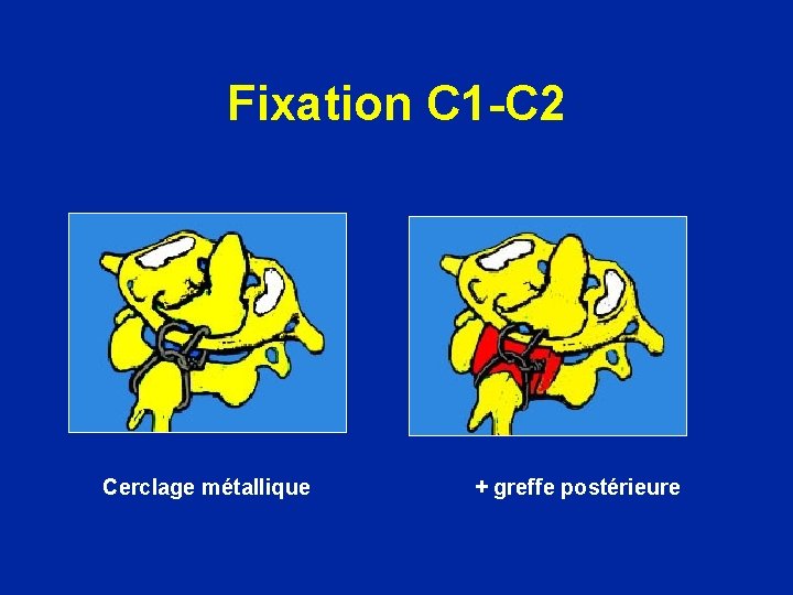 Fixation C 1 -C 2 Cerclage métallique + greffe postérieure 