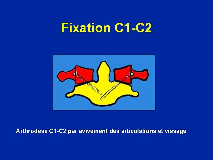 Fixation C 1 -C 2 Arthrodèse C 1 -C 2 par avivement des articulations