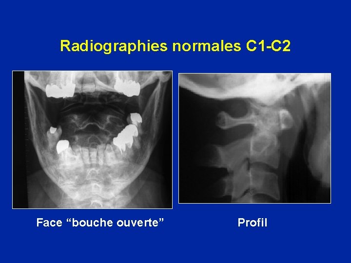 Radiographies normales C 1 -C 2 Face “bouche ouverte” Profil 