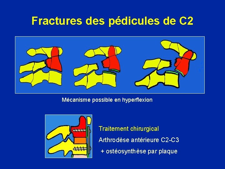 Fractures des pédicules de C 2 Mécanisme possible en hyperflexion Traitement chirurgical Arthrodèse antérieure
