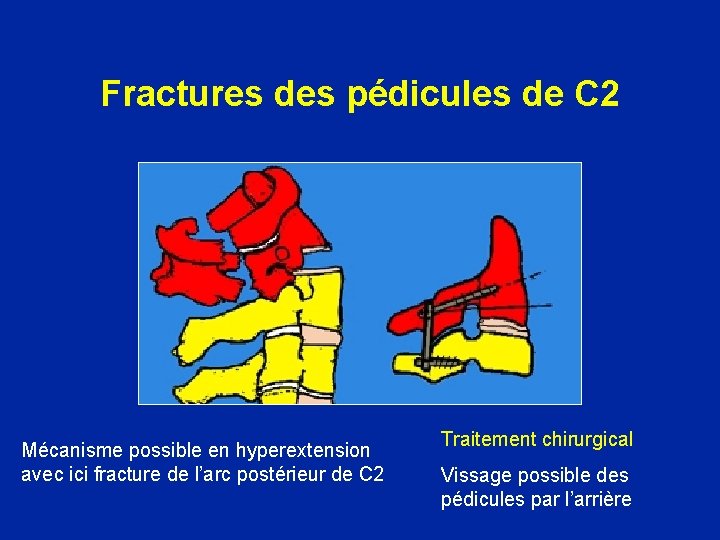 Fractures des pédicules de C 2 Mécanisme possible en hyperextension avec ici fracture de