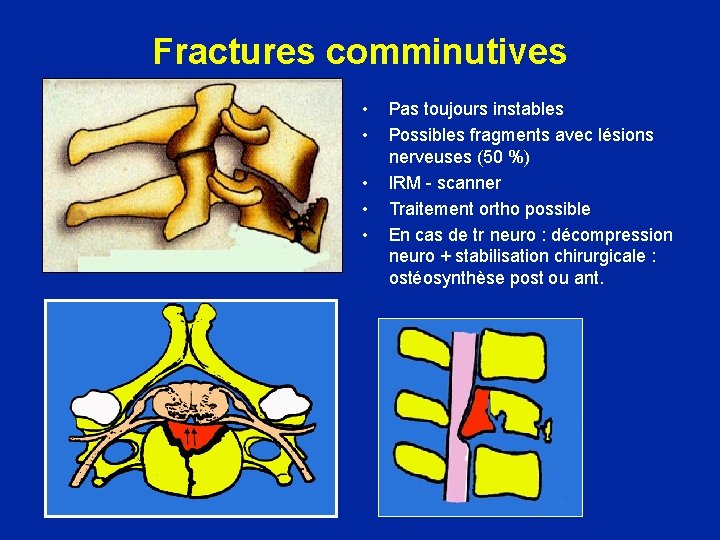 Fractures comminutives • • • Pas toujours instables Possibles fragments avec lésions nerveuses (50