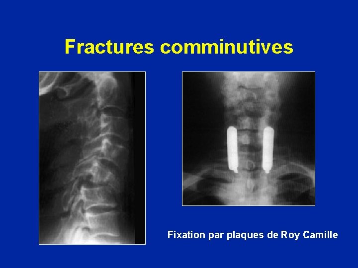 Fractures comminutives Fixation par plaques de Roy Camille 