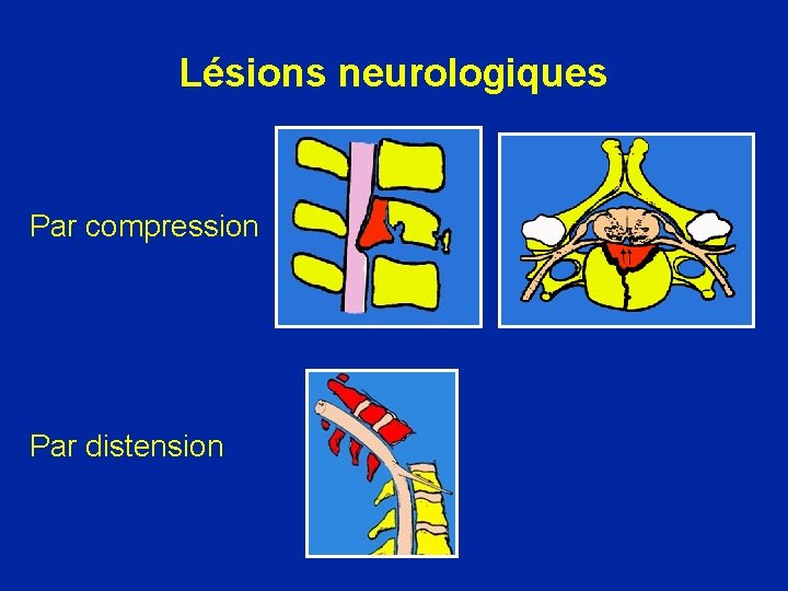 Lésions neurologiques Par compression Par distension 