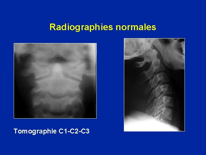 Radiographies normales Tomographie C 1 -C 2 -C 3 