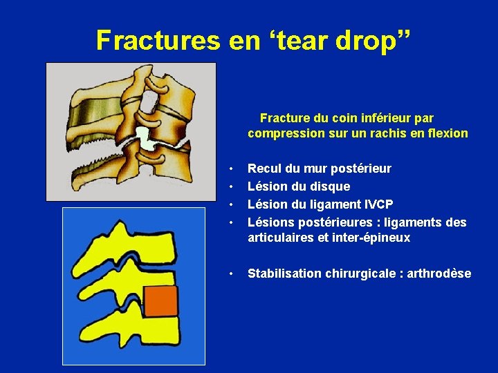 Fractures en ‘tear drop” Fracture du coin inférieur par compression sur un rachis en