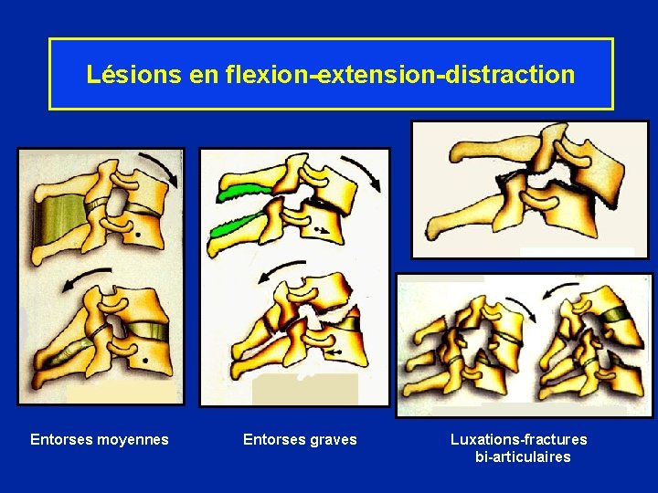 Lésions en flexion-extension-distraction Entorses moyennes Entorses graves Luxations-fractures bi-articulaires 