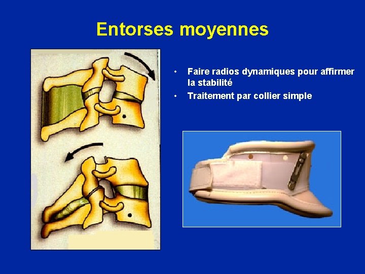 Entorses moyennes • • Faire radios dynamiques pour affirmer la stabilité Traitement par collier